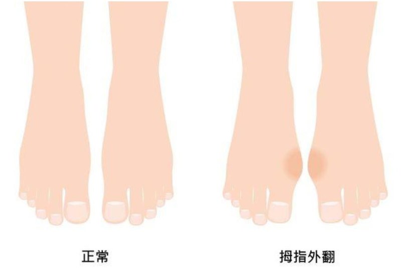种籽骨障碍:脚拇趾根部的拇趾球剧痛,一般左脚比右脚常见 如果你