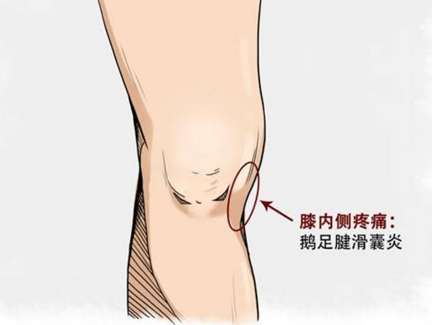 膝盖内侧疼痛怎么办?
