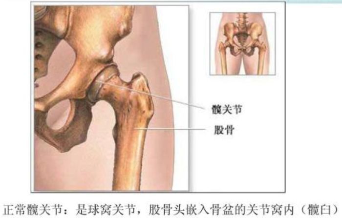 髋关节屈肌受伤的常见原因与处理