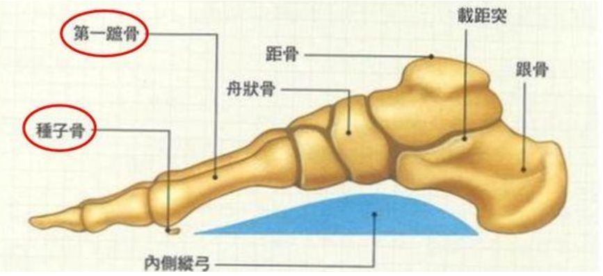 拇指外翻﹕脚拇趾根部附近发生剧痛,拇趾往小趾方向偏移导致脚内侧向