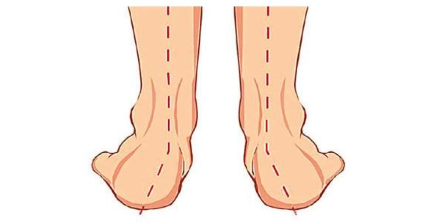脚跟走路以训练小腿前侧肌肉肌力),但若发现属于有合并足外翻的扁平足