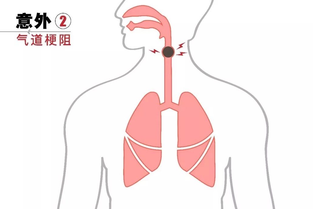 轻微的气道梗阻