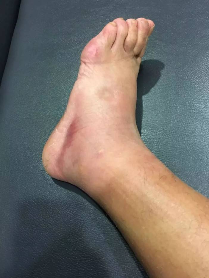 手术前脚部有所变形