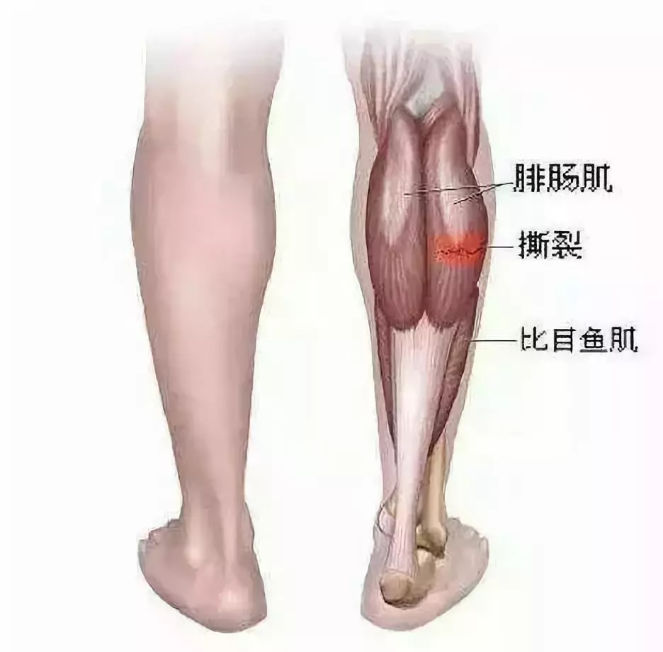 在日常运动中,大腿后侧腘绳肌群的拉伤十分常见.