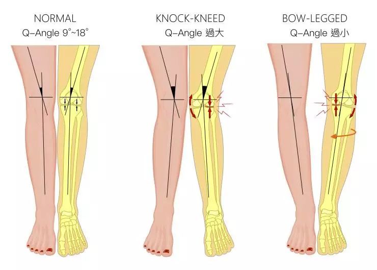 左:正常 中:x型腿,q角过大 右:o型腿,q角过小 现代人坐着时间长,古梃