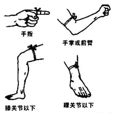 毒蛇咬伤包扎位示意图