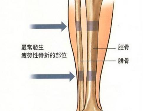 腓骨痛图片