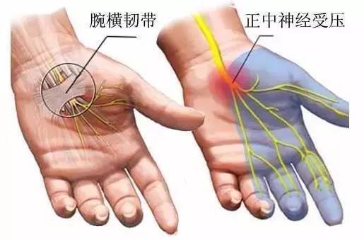 手麻是重大疾病吗? | 健康一分钟