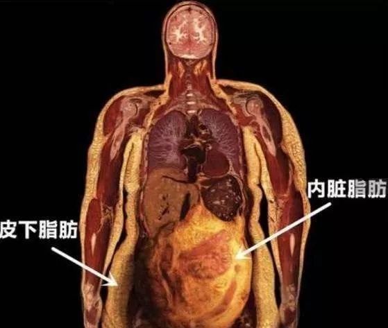 减肥误区:千万不能只减皮下脂肪