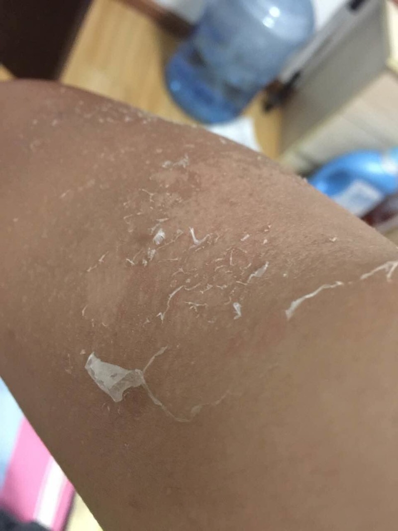 被晒后,开始脱皮了